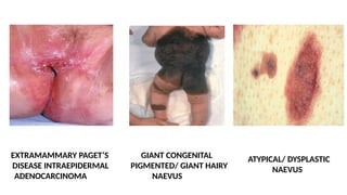 EXTRAMAMMARY PAGET’S
DISEASE INTRAEPIDERMAL
ADENOCARCINOMA
GIANT CONGENITAL
PIGMENTED/ GIANT HAIRY
NAEVUS
ATYPICAL/ DYSPLASTIC
NAEVUS
 