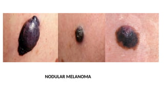 NODULAR MELANOMA
 