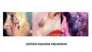 LENTIGO MALIGNA MELANOMA
 