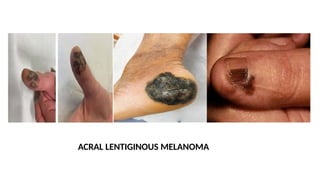 ACRAL LENTIGINOUS MELANOMA
 