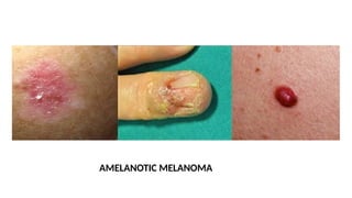 AMELANOTIC MELANOMA
 