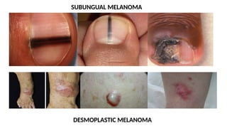 DESMOPLASTIC MELANOMA
SUBUNGUAL MELANOMA
 