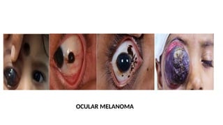 OCULAR MELANOMA
 