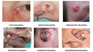 CYSTIC MELANOMA NODULAR MELANOMA NODULOCYSTIC MELANOMA
PIGMENTED MELANOMA ULCERATIVE MELANOMA ULCERONODULAR MELANOMA
 