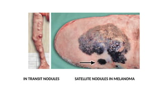 IN TRANSIT NODULES SATELLITE NODULES IN MELANOMA
 