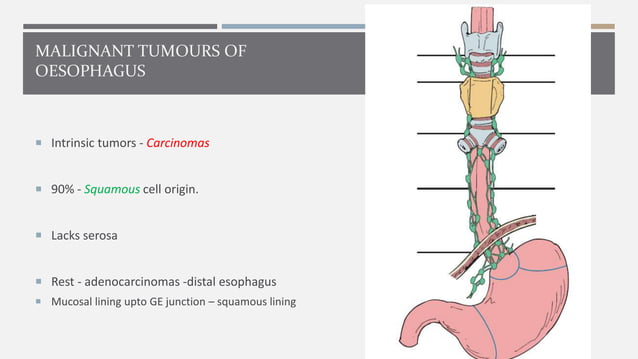 Malignant tumors of esophagus | PPTX | Digestive Disorders | Diseases ...