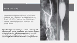 Malignant tumors of esophagus | PPTX
