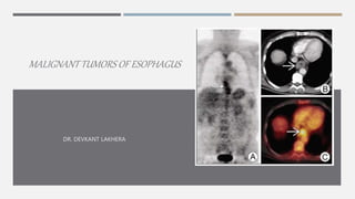 MALIGNANT TUMORS OF ESOPHAGUS
DR. DEVKANT LAKHERA
 