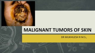 MALIGNANT TUMORS OF SKIN
DR MUKHILESH R M.S.,

 