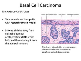 Malignant tumours of the skin | PPTX