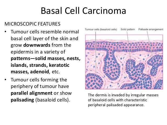 Malignant tumours of the skin