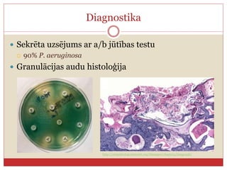 Diagnostika
 Sekrēta uzsējums ar a/b jūtības testu
 90% P. aeruginosa
 Granulācijas audu histoloģija
http://otopathologynetwork.org/tbimages/chapter5/image436/
 