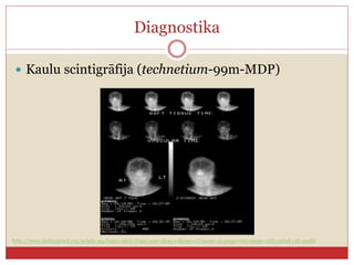 Diagnostika
 Kaulu ԳپھᲹ (technetium-99m-MDP)
http://www.indianjotol.org/article.asp?issn=0971-7749;year=2011;volume=17;issue=4;spage=165;epage=166;aulast=Al-otaibi
 
