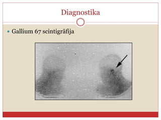 Diagnostika
 Gallium 67 ԳپھᲹ
 