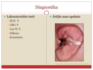 Diagnostika
 Laboratoriskie testi
 EGĀ ↑
 CRO ↑
 Leu N/↑
 Glikoze
 Kreatinīns
 Ārējās auss apskate
http://www.aafp.org/afp/2006/1101/p1510.html
 