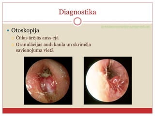 Diagnostika
 Otoskopija
 Čūlas ārējās auss ejā
 Granulācijas audi kaula un skrimšļa
savienojuma vietā
http://gpent.blogspot.com/2013/02/definition-oe-is-inflammatory-typically_11.html
http://eac.hawkelibrary.com/new/main.php?g2_itemId=353&g2_imageViewsIndex=1
 