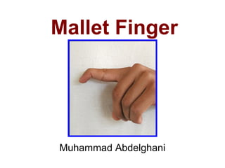 Mallet Finger 
Muhammad Abdelghani 
 