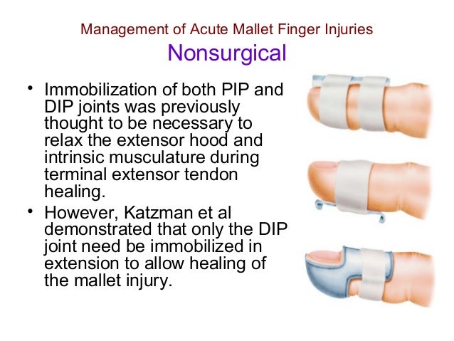 MALLET FINGER REHABILITATION EPUB MALLET FINGER REHABILITATION EPUB