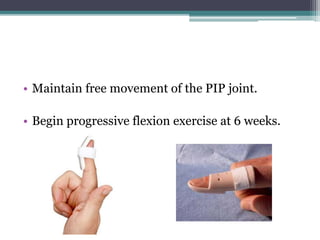• Maintain free movement of the PIP joint.
• Begin progressive flexion exercise at 6 weeks.
 