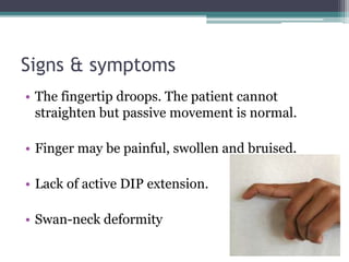 Signs & symptoms
• The fingertip droops. The patient cannot
straighten but passive movement is normal.
• Finger may be painful, swollen and bruised.
• Lack of active DIP extension.
• Swan-neck deformity
 