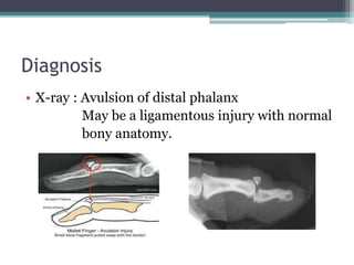 Diagnosis
• X-ray : Avulsion of distal phalanx
May be a ligamentous injury with normal
bony anatomy.
 
