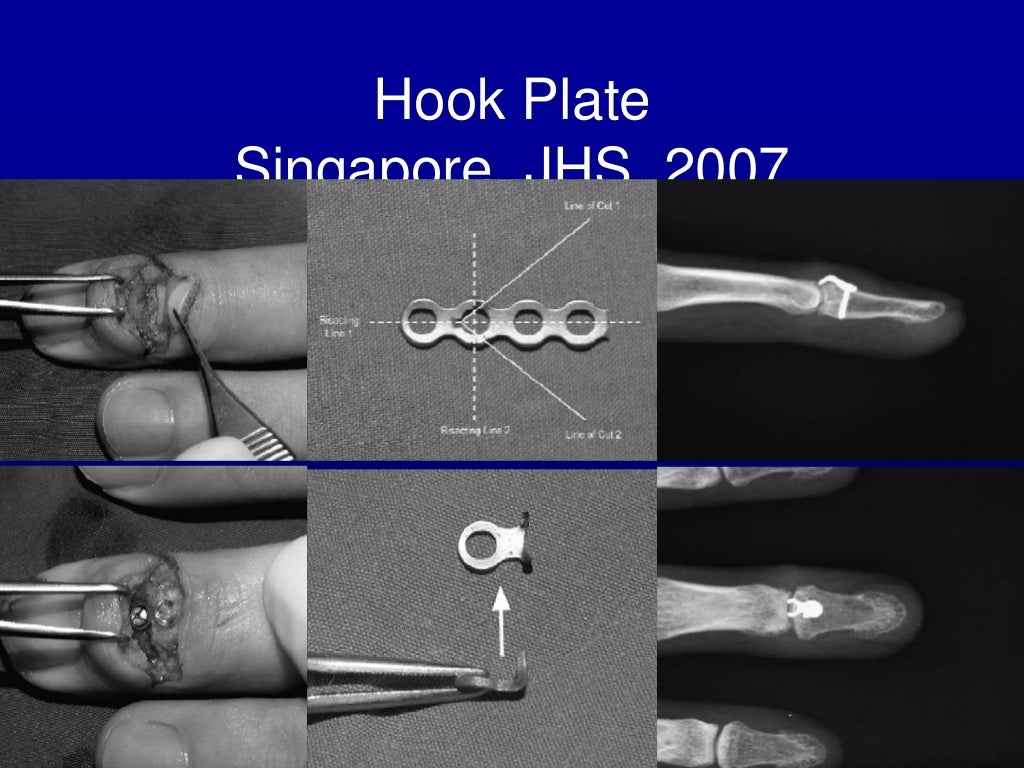 Percutaneous pin fixation of the mallet fracture, review of the techn…