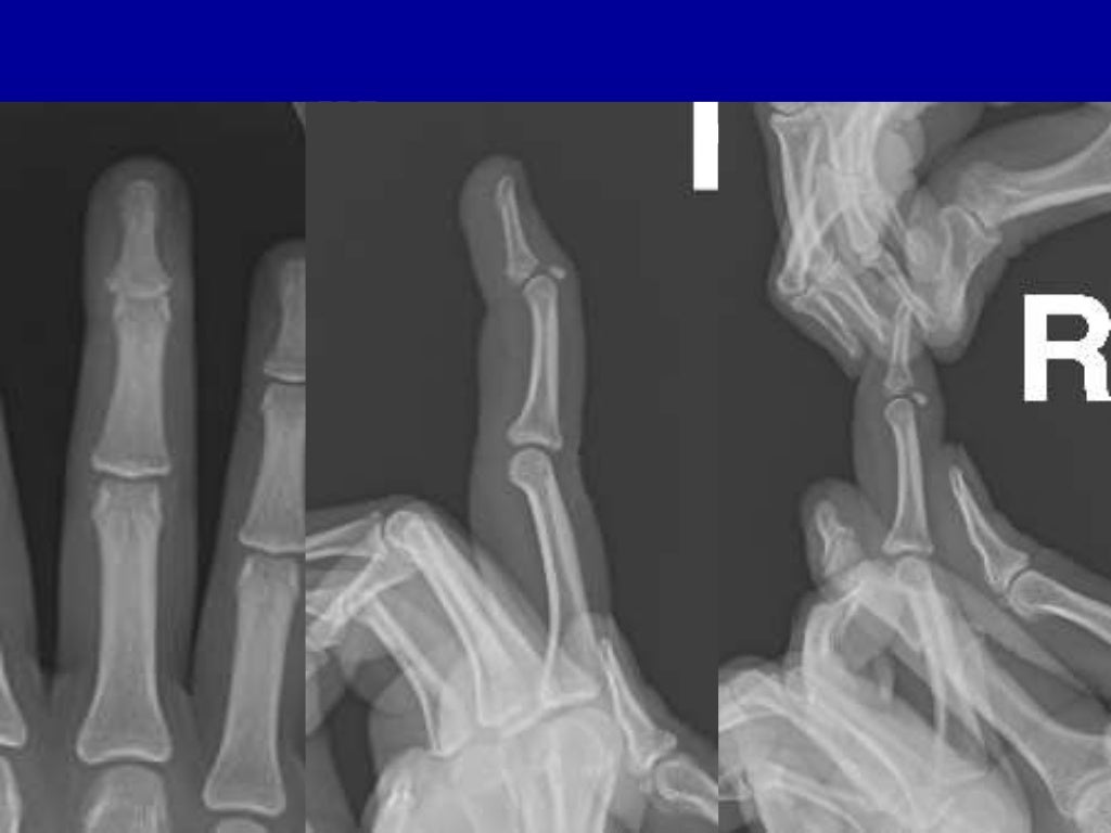 Percutaneous pin fixation of the mallet fracture, review of the techn…