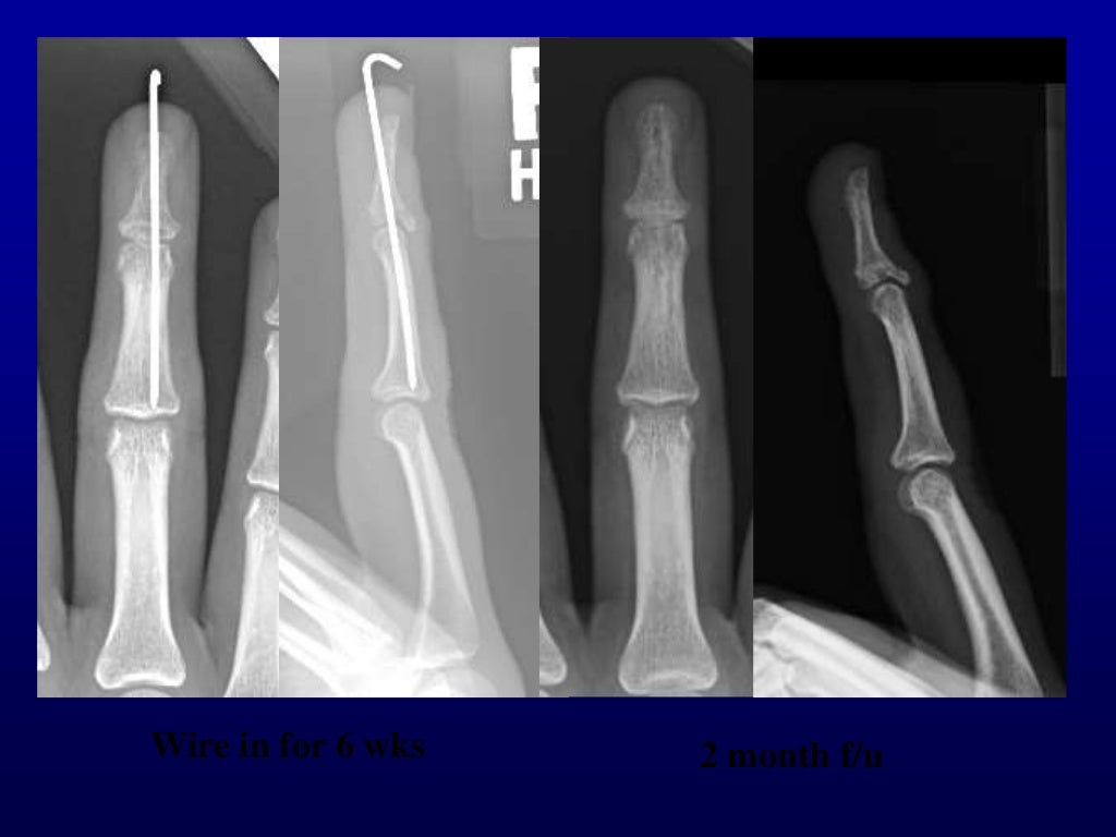 Percutaneous pin fixation of the mallet fracture, review of the techn…
