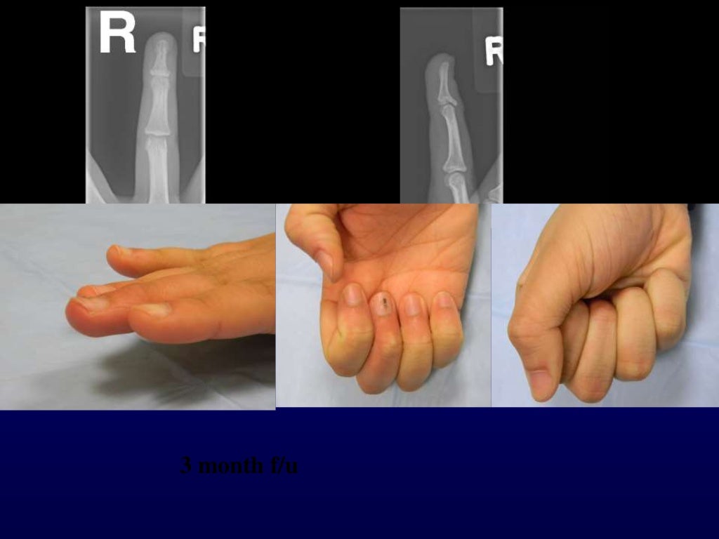 Percutaneous pin fixation of the mallet fracture, review of the techn…
