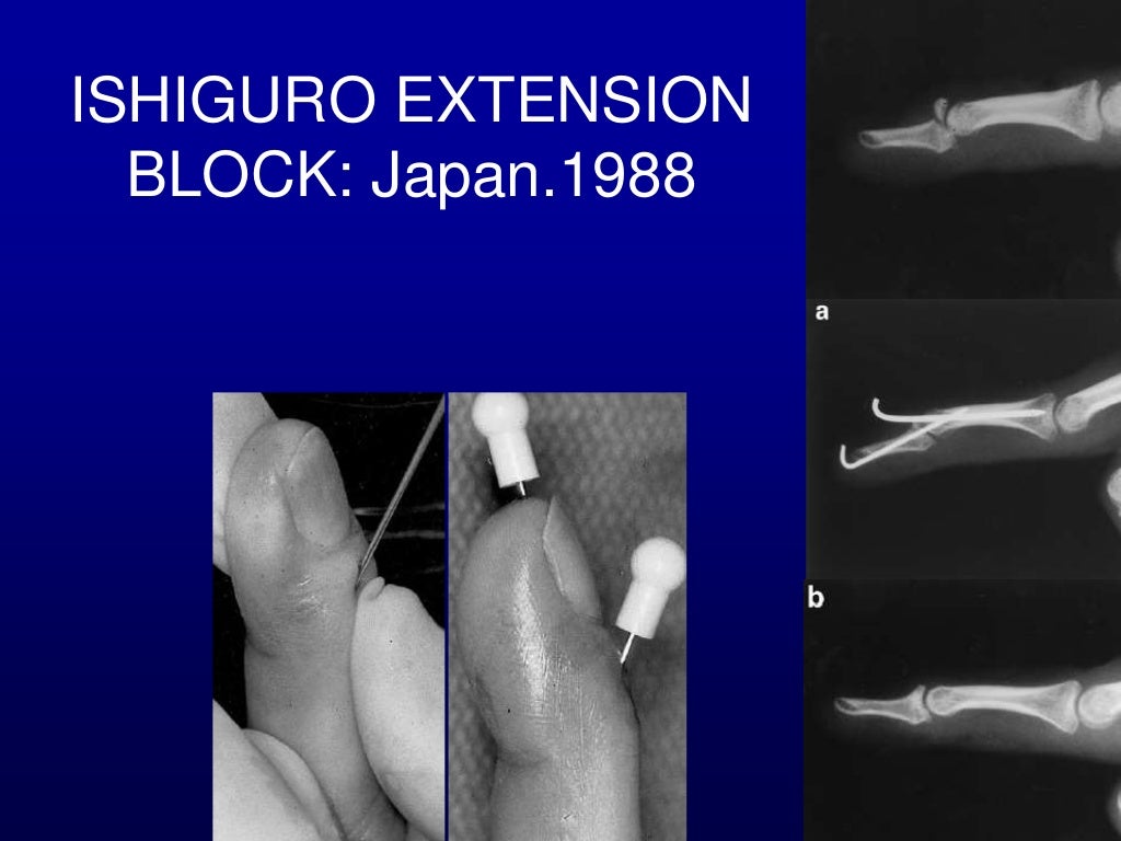 Percutaneous pin fixation of the mallet fracture, review of the techn…