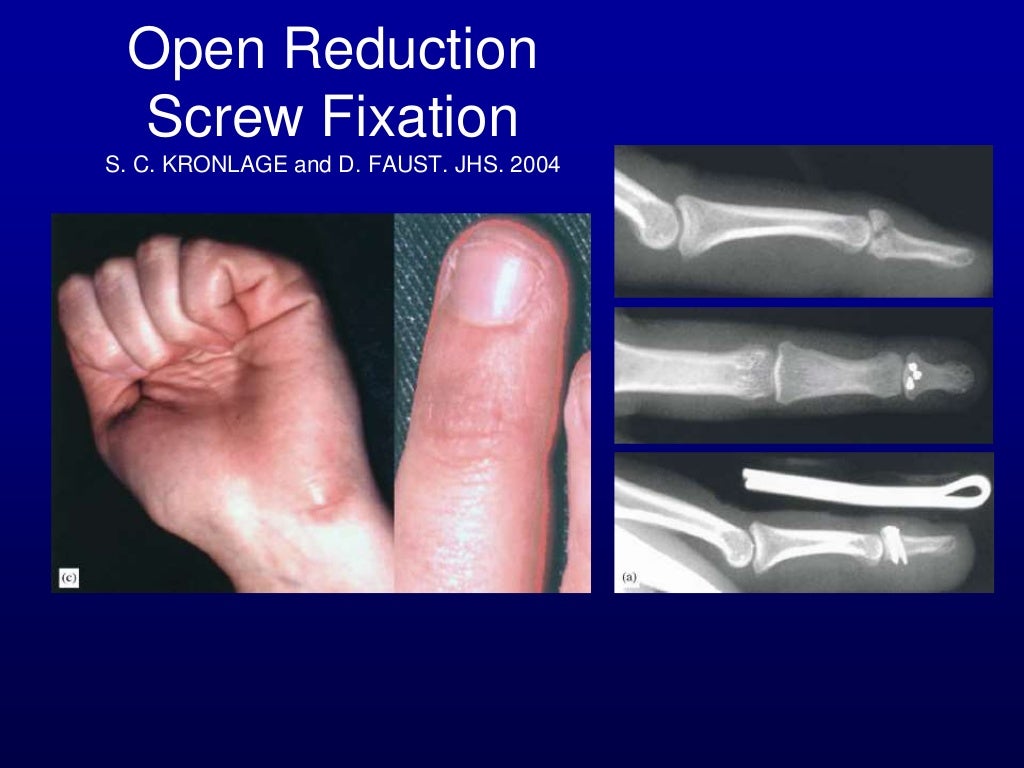 Percutaneous pin fixation of the mallet fracture, review of the techn…
