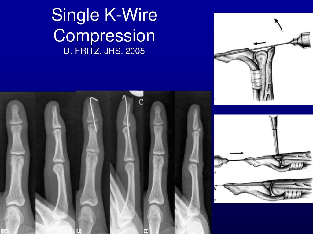 Percutaneous pin fixation of the mallet fracture, review of the techn…