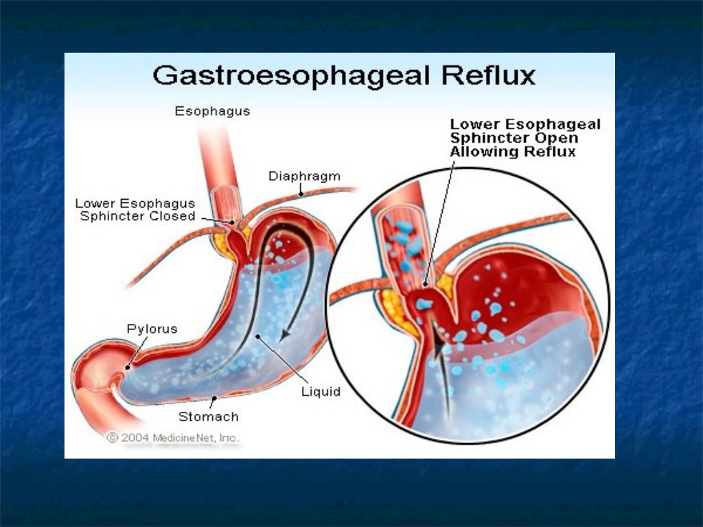 Mallory weiss syndrome