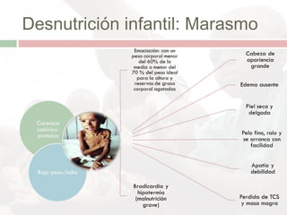 Desnutrición infantil: Marasmo
 