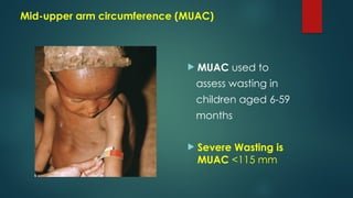 Muac Guidelines Malnutrition. presentation made simple | PPTX