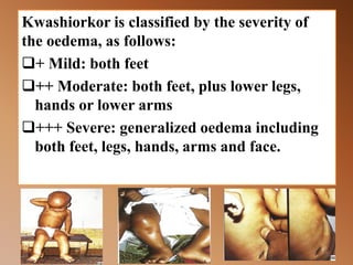 Kwashiorkor is classified by the severity of
the oedema, as follows:
+ Mild: both feet
++ Moderate: both feet, plus lower legs,
hands or lower arms
+++ Severe: generalized oedema including
both feet, legs, hands, arms and face.
 