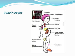 kwashiorkor
 