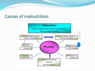 Causes of malnutrition
 