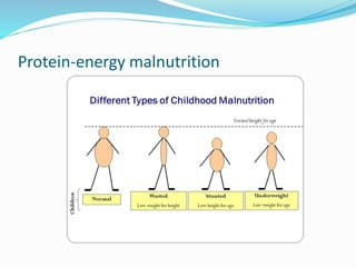 Protein-energy malnutrition
 