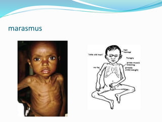 marasmus
 