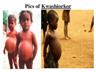Pics of Kwashiorkor
 