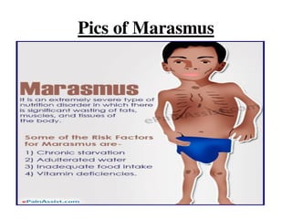 Pics of Marasmus
 