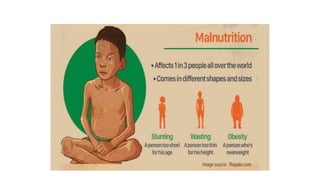 Malnutrition.pptx