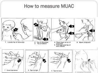 Muac Guidelines malnutrition, clinical features and management 2.ppt