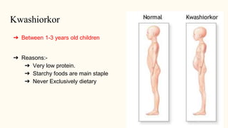 Kwashiorkor
➔ Between 1-3 years old children
➔ Reasons:-
➔ Very low protein.
➔ Starchy foods are main staple
➔ Never Exclusively dietary
 