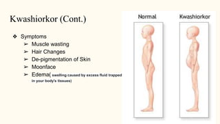 Kwashiorkor (Cont.)
❖ Symptoms
➢ Muscle wasting
➢ Hair Changes
➢ De-pigmentation of Skin
➢ Moonface
➢ Edema( swelling caused by excess fluid trapped
in your body's tissues)
 
