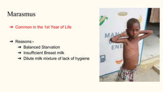 Marasmus
➔ Common in the 1st Year of Life
➔ Reasons:-
➔ Balanced Starvation
➔ Insufficient Breast milk
➔ Dilute milk mixture of lack of hygiene
 