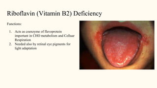 Riboflavin (Vitamin B2) Deficiency
Functions:
1. Acts as coenzyme of flavoprotein
important in CHO metabolism and Celluar
Respiration
2. Needed also by retinal eye pigments for
light adaptation
 