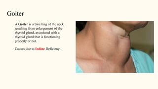 Goiter
A Goiter is a Swelling of the neck
resulting from enlargement of the
thyroid gland, associated with a
thyroid gland that is functioning
properly or not.
Causes due to Iodine Deficieny.
 