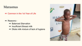 Marasmus
➔ Common in the 1st Year of Life
➔ Reasons:-
➔ Balanced Starvation
➔ Insufficient Breast milk
➔ Dilute milk mixtu...